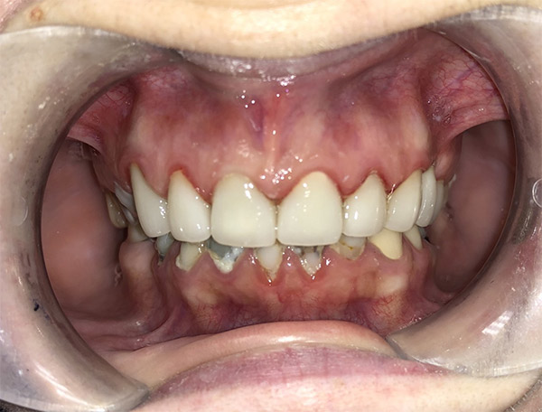 After-Teeth Bonding