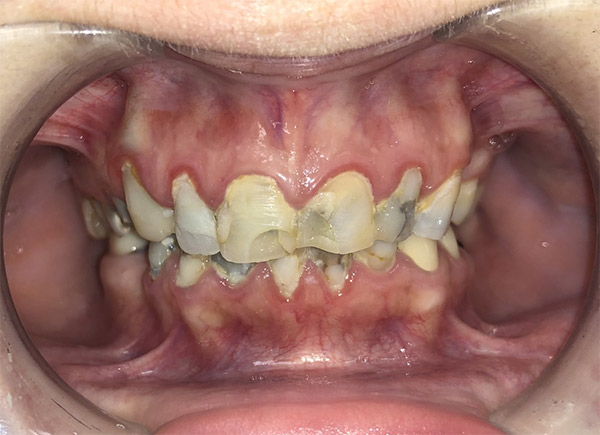 Before-Teeth Bonding