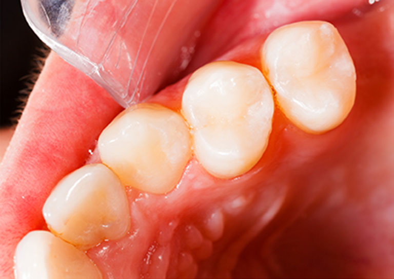After-Early stage Cavities after