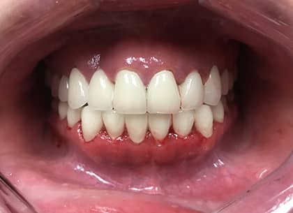 After-Dental Crowns