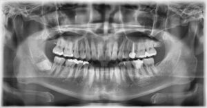 VaTech Panoramic X-ray with 3D Cone Beam Computed Tomography (CBCT)