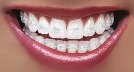 Brooklyn NY Ceramic Braces