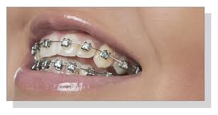 Metal Braces