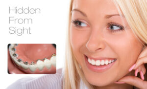 Lingual Braces (pros and cons, problems)