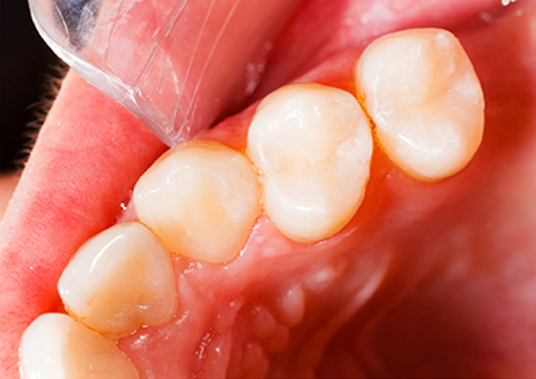 Before & After Smile Gallery Broadway Family Dental Brooklyn, NY