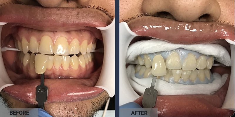 Before After GLO Teeth Whitening in Brooklyn NY (2)