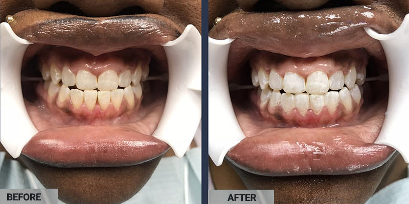 Before After GLO Teeth Whitening in Brooklyn NY