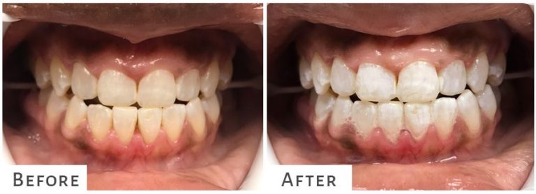 Before and After Teeth Whitening in Brooklyn NY