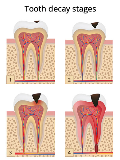 Tooth Decay Stages