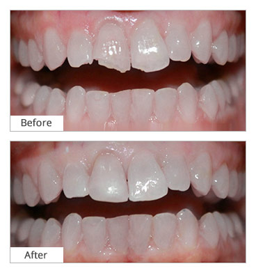 Chipped Tooth - Emergency Dental Care - Before and After in Brooklyn, NY