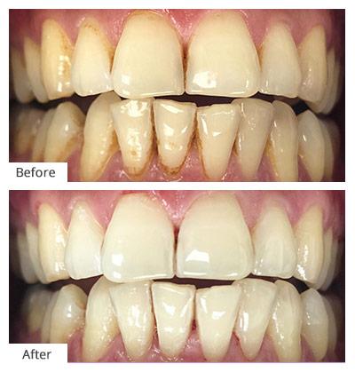 Deep Cleaning vs. Normal Cleaning for Teeth - Eagle Dental