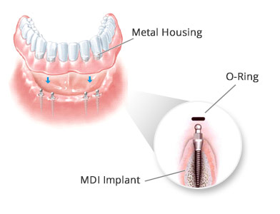 Mini Dental Implants in Brooklyn