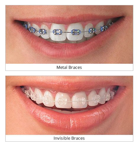 Braces invisible What Is