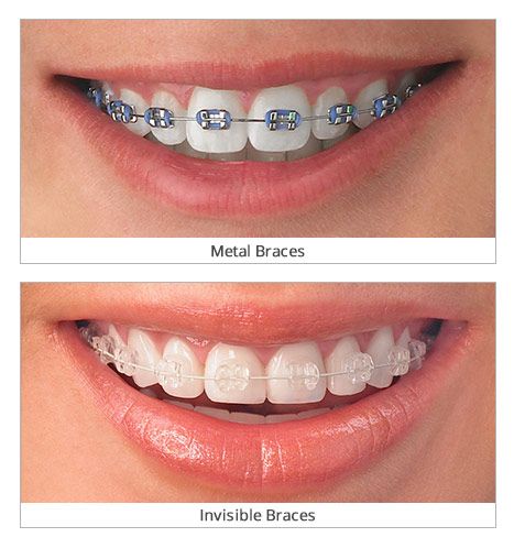 Invisible braces, Clear dental braces, Teeth braces