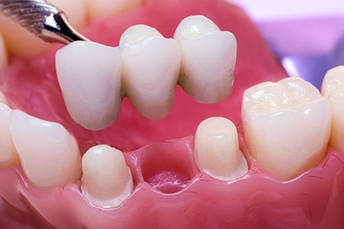 Teeth Bridge Procedure