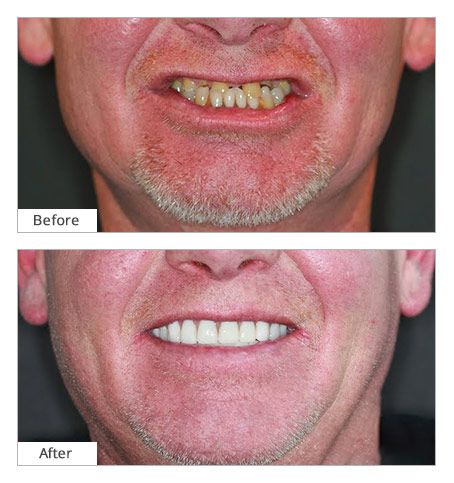 tooth implant before after