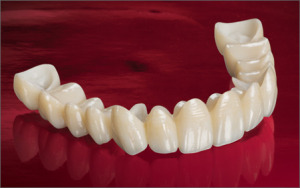 Bruxzir Solid Zirconia Crowns