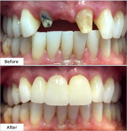 Lava Crowns