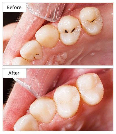 Porcelain Fillings Before and After