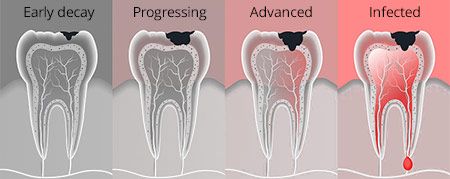 Tooth Decay Treatment in Brooklyn