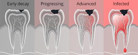 dental caries treatment