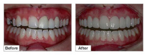 Dental Veneers Before and After