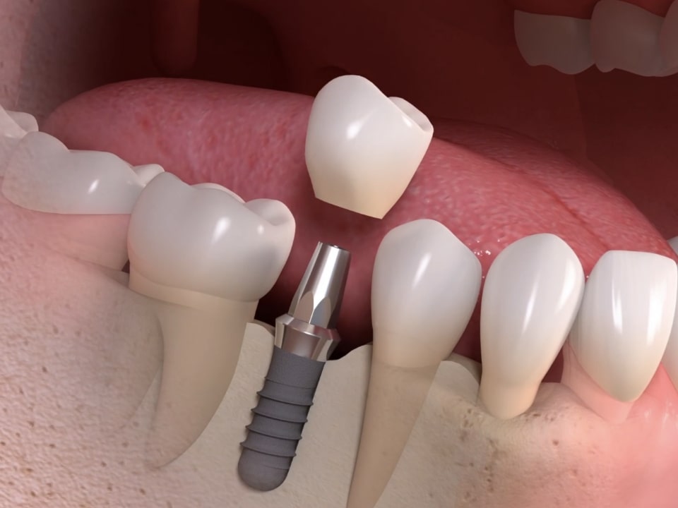 dental implants