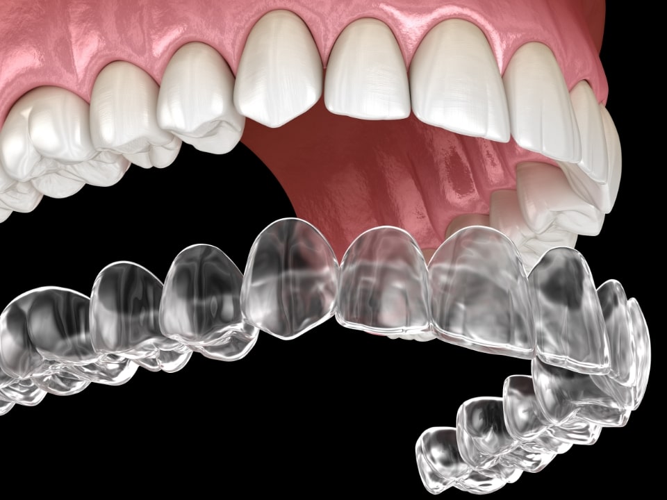 invisalign