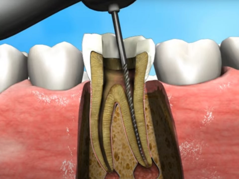 root canal