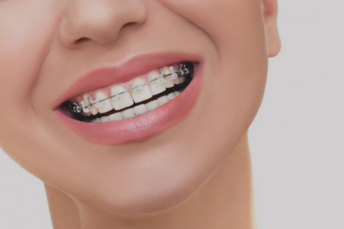 Adult Braces