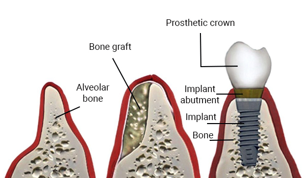 Bone Grafting for Dental Implants