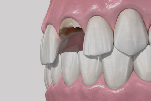 Before & After, Cracked Tooth Repair Images