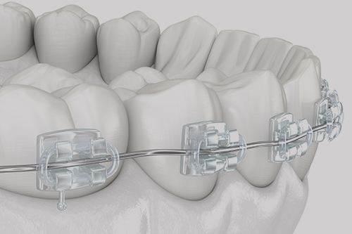 Clear Ceramic Braces