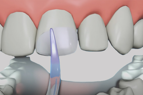 Cosmetic Dental Bonding