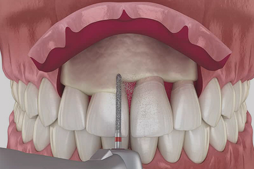 Crown Lengthening Procedure