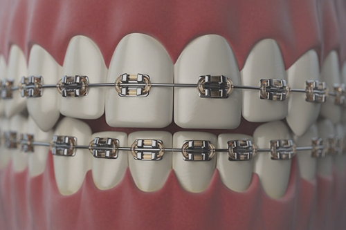 Dental Braces in Brooklyn, NY - Broadway Family Dental