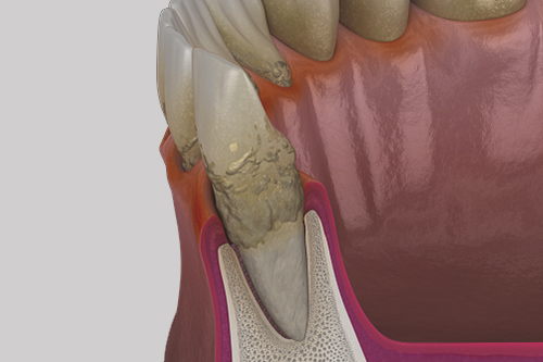 Gum Disease