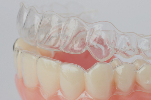 Overlapping Teeth Invisalign