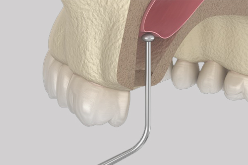 Sinus Lift Surgery