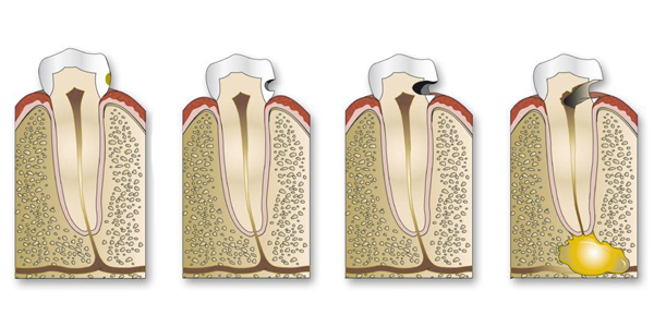 The Progression of a Cavity