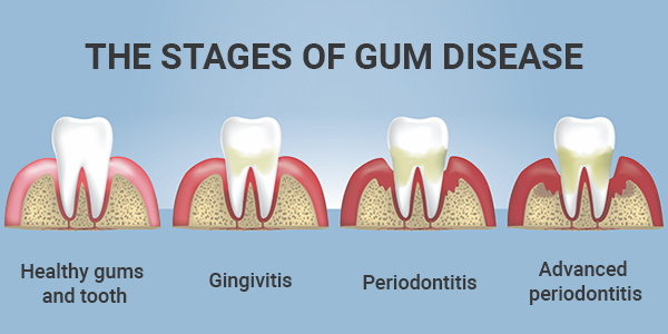 The Stages of Gum Disease