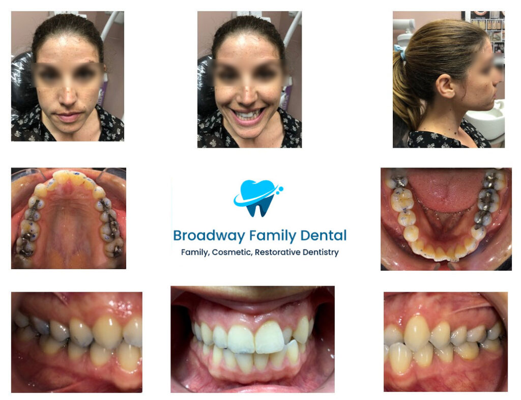 Invisalign Braces Brooklyn, NY Clear Aligners New York