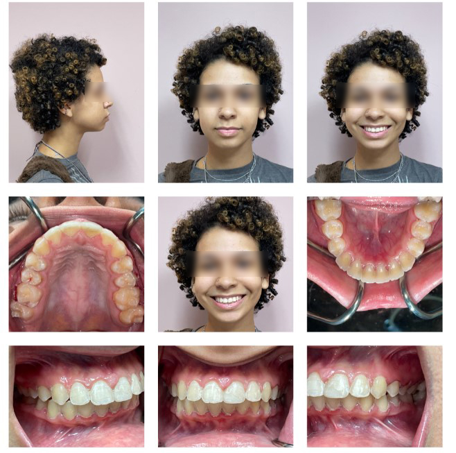 Harlem Center for Aesthetic Dentistry - New York, NYC, Manhattan - ceramic  braces