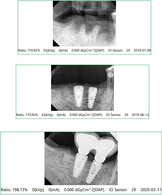 Dental Implant X-Ray Before and After