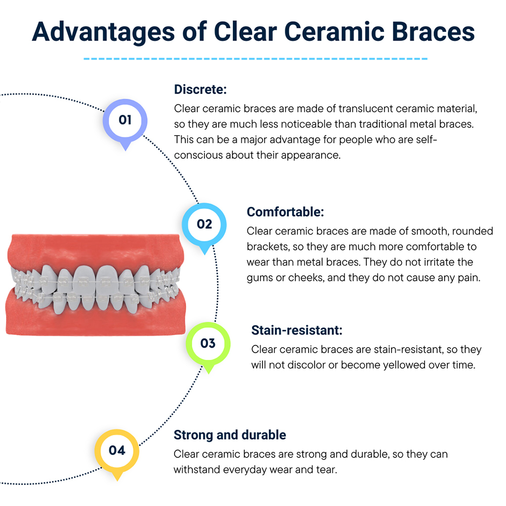 Advantages of Clear Ceramic Braces