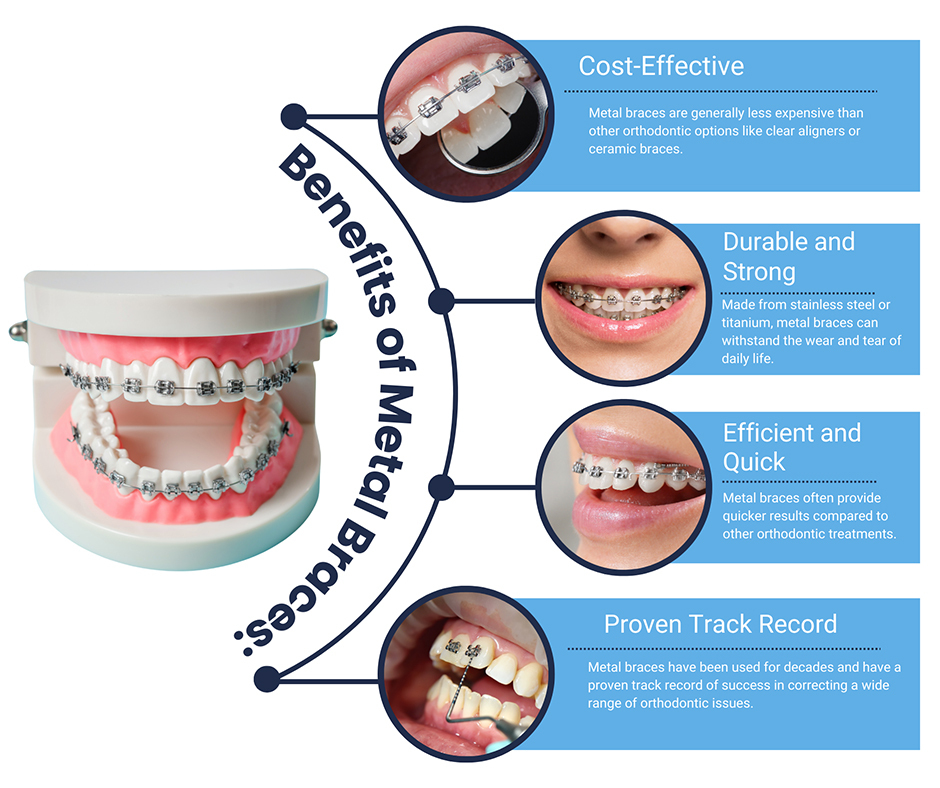 Benefits of Metal Braces