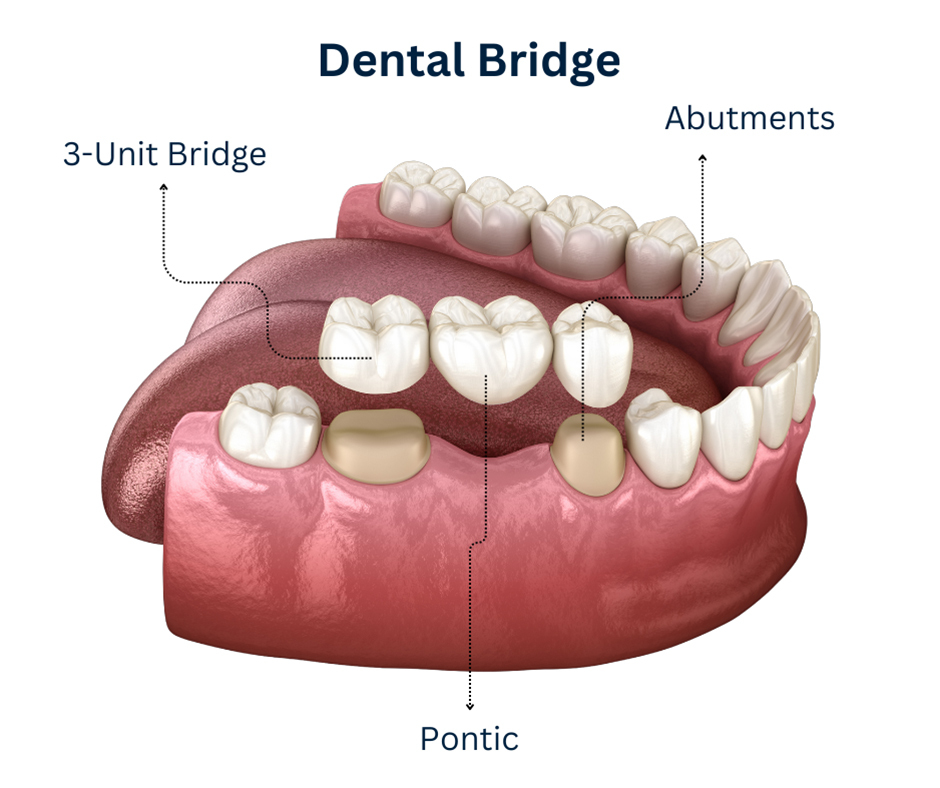 Dental Bridges Maple Ridge