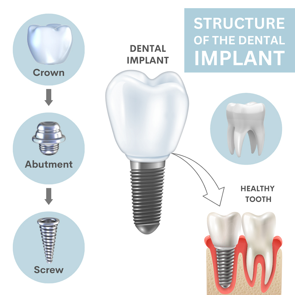 Dental Implant Structure