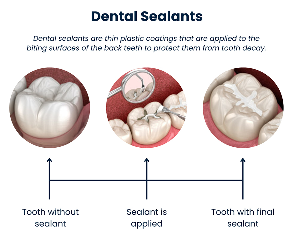 Dental Sealants