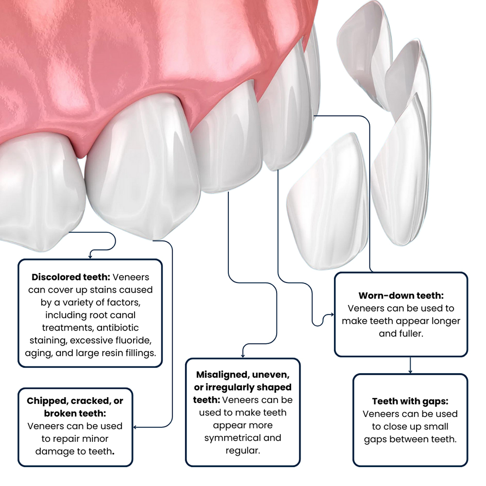 Problems Corrected by Veneers for Teeth